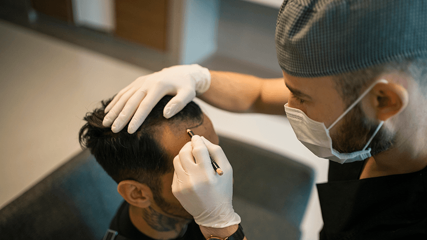 surgeon in surgical mask drawing line on man's head to prepare for hair transplant